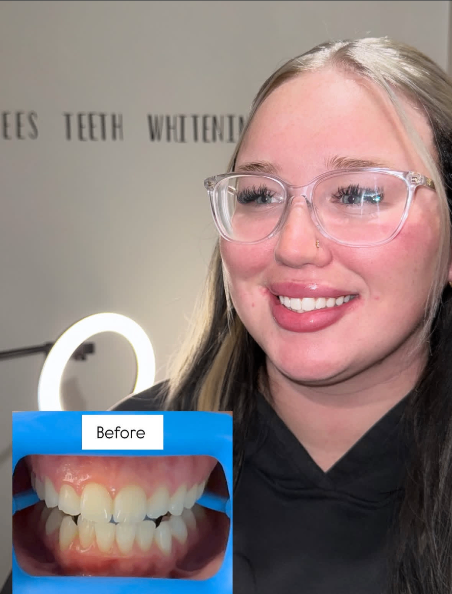 Confident new white smile — leaving the studio