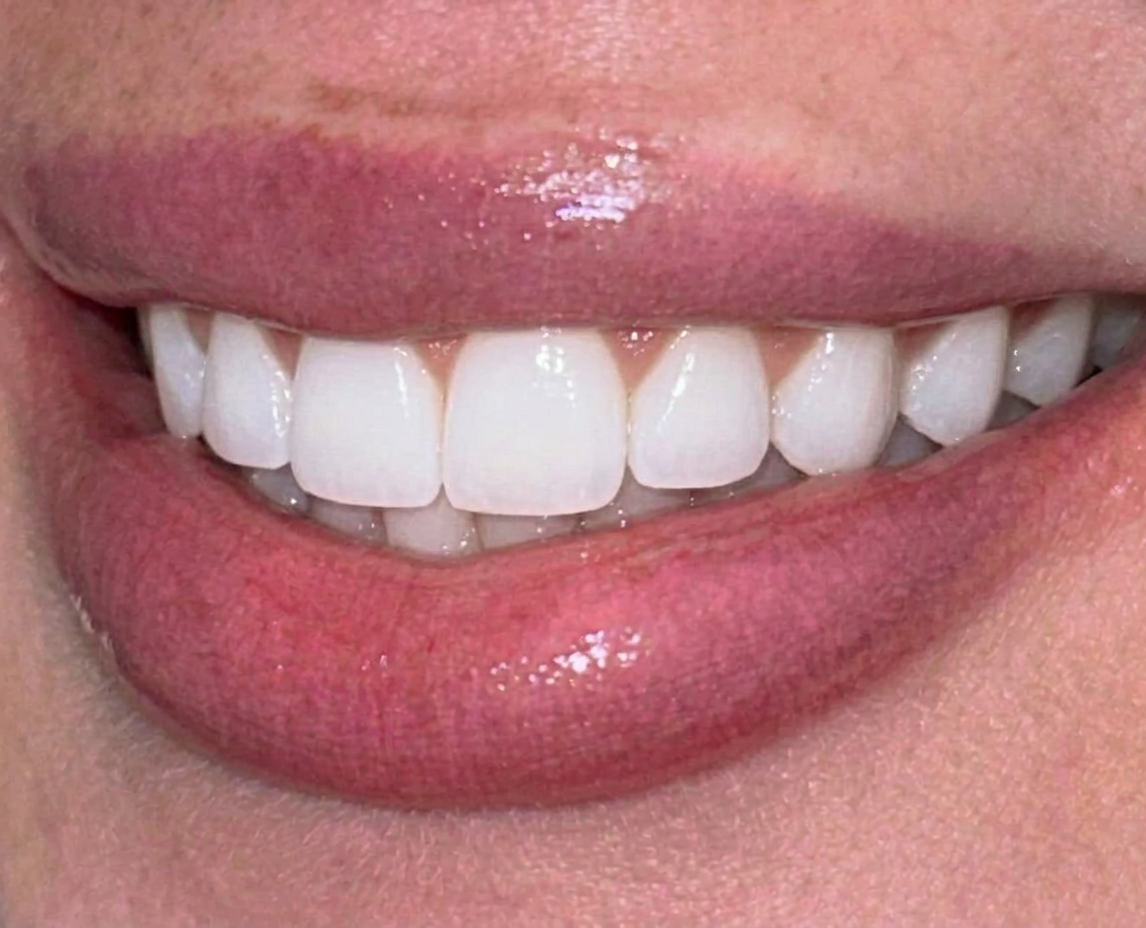 Bright white smile after teeth whitening treatment